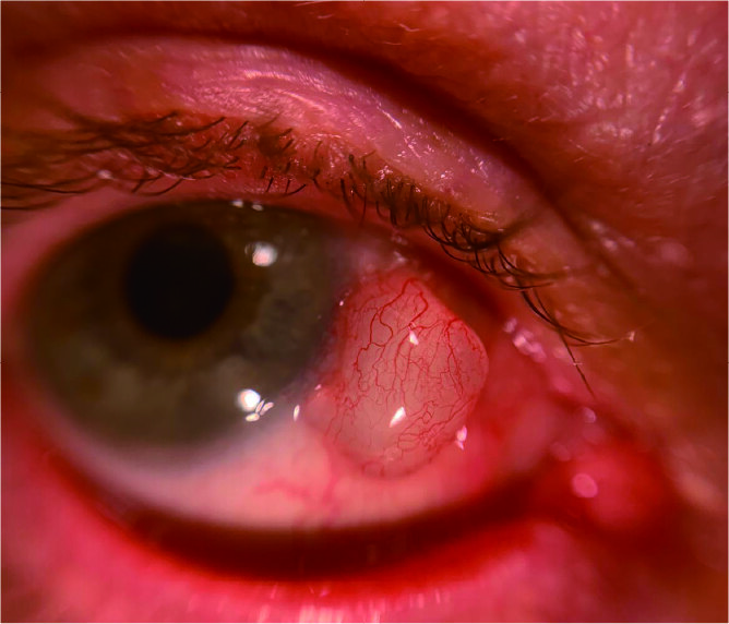 Corneal Cyst