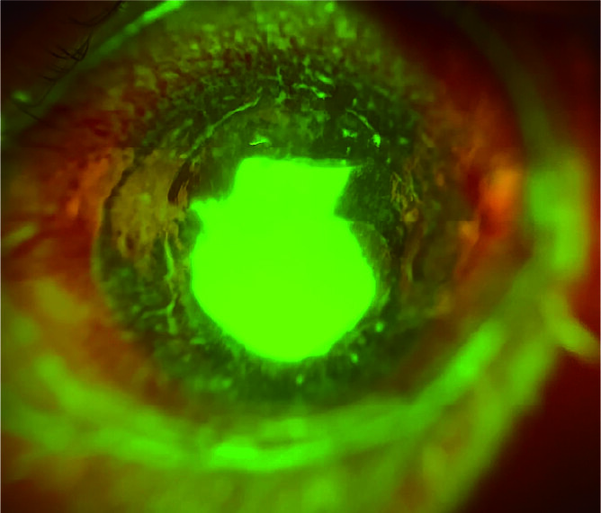 Corneal Ulcer