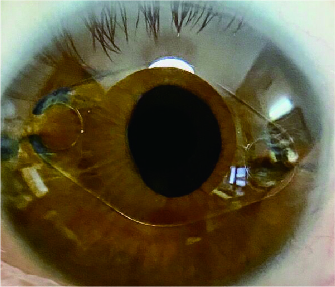 ICL Implant
