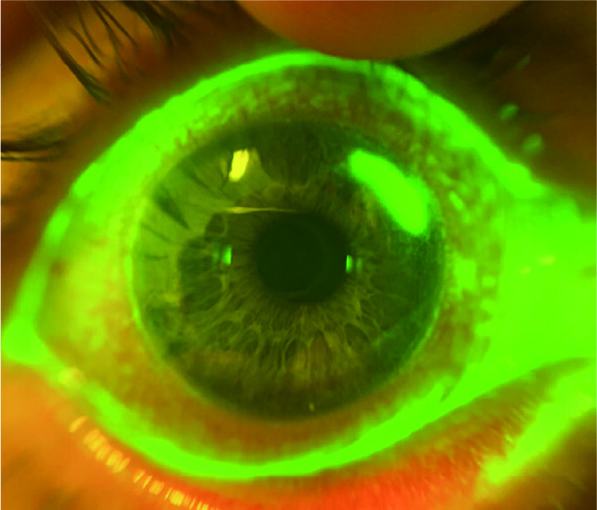 Marginal Keratitis