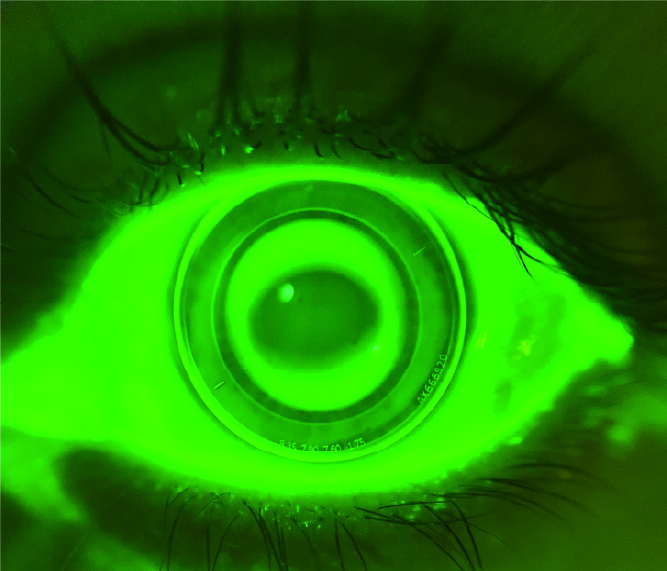 Ortho-K Lens Fitting