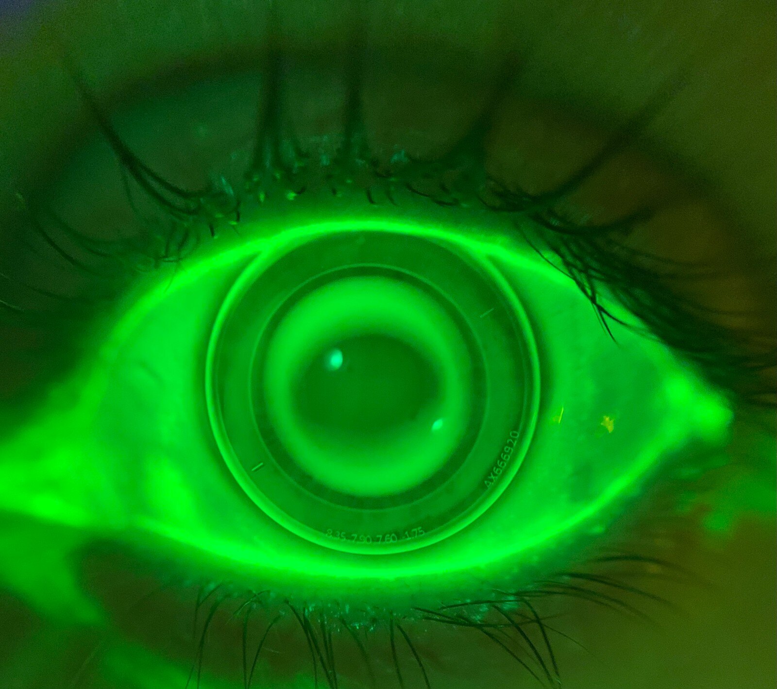 Check Ortho-K Lens Fit Anytime, Anywhere